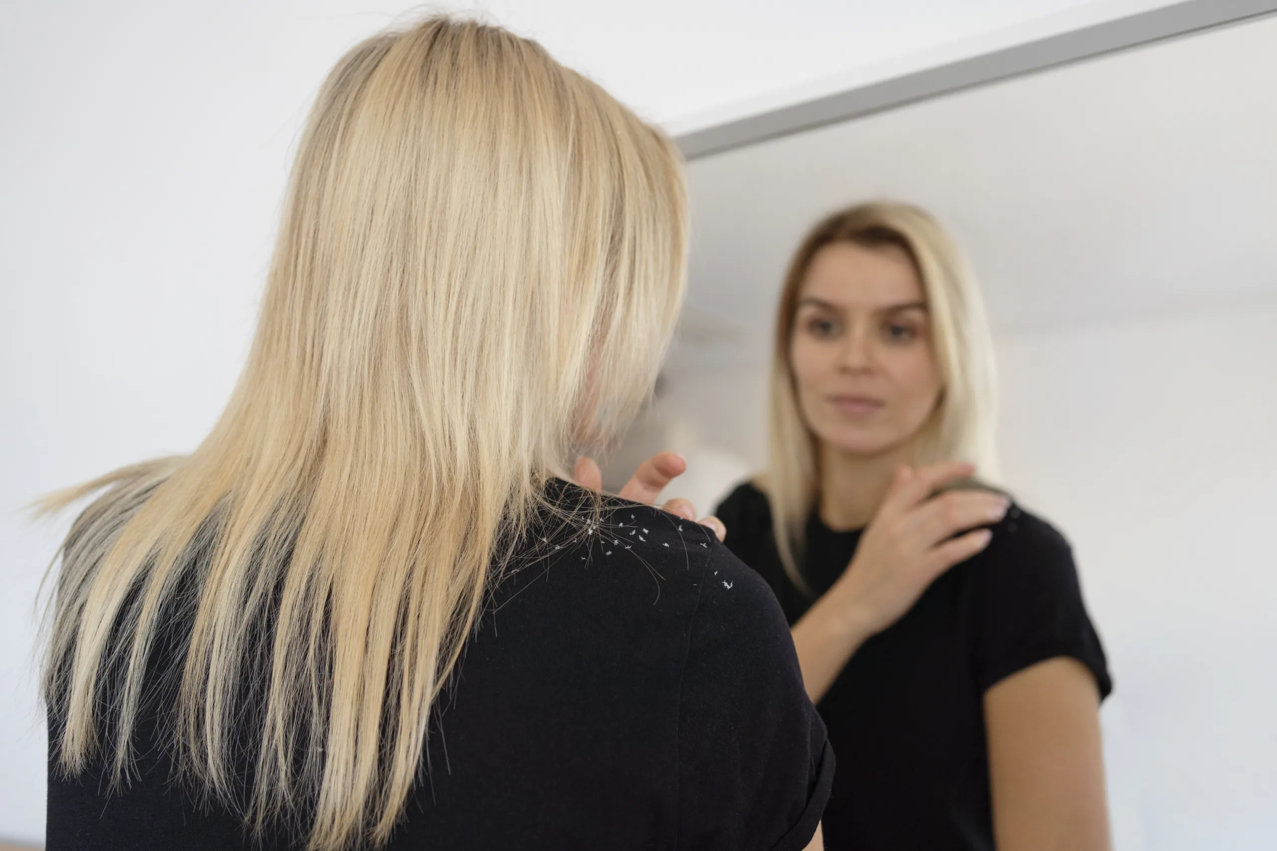 How to Get Rid of Dandruff