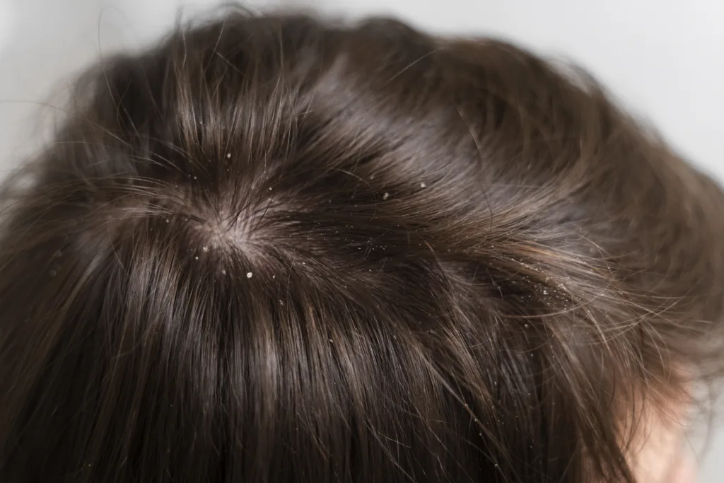 Dandruff