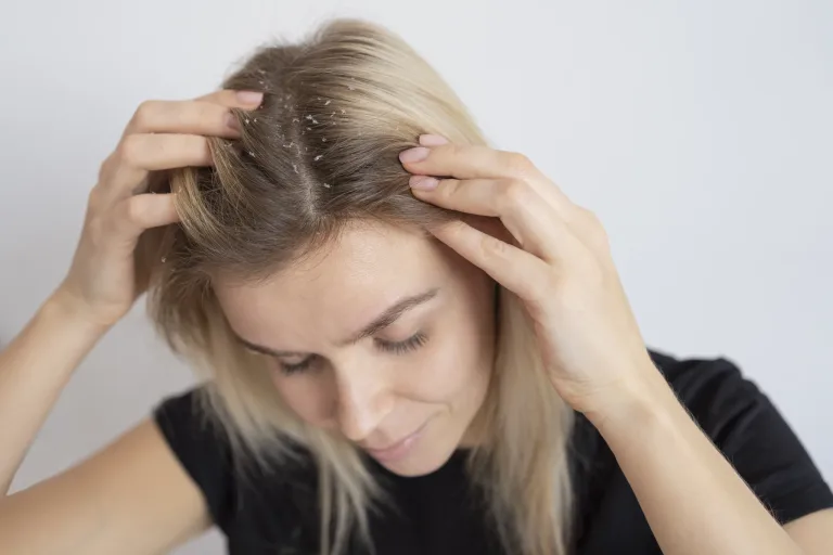 How to Get Rid of Dandruff